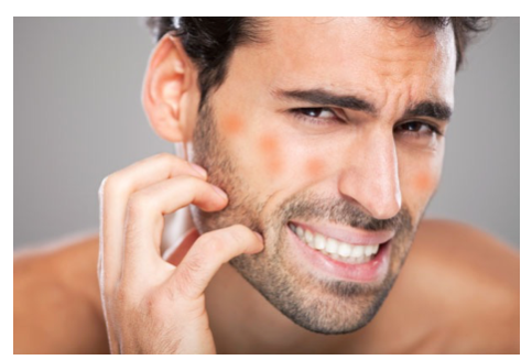 What Are Razor Bumps